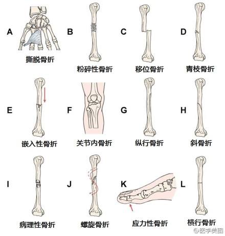 什么风水容易出现骨折